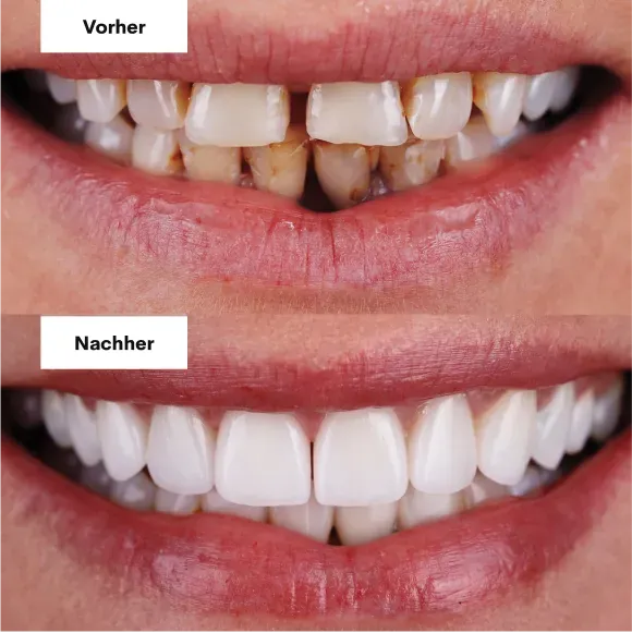 Zähne vorher und nachher mit Veneers, Beispiel 4
