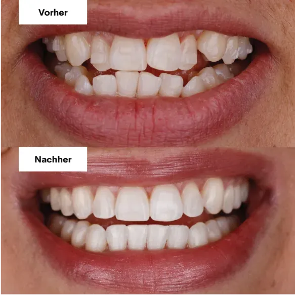 Vorher und nachher mit Alignern, Patient 2