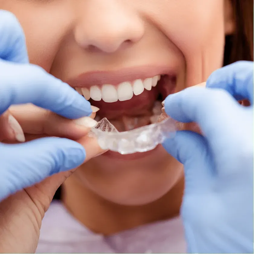 Invisalign Aligner