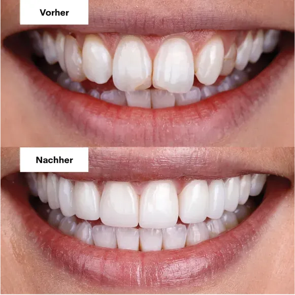 Zähne vorher und nachher mit Veneers, Beispiel 3
