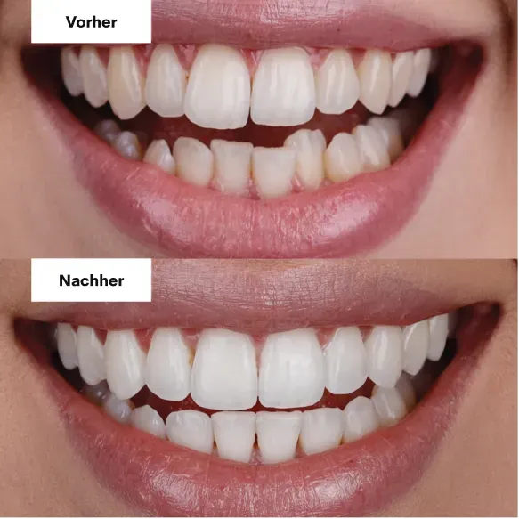 Vorher und nachher mit Alignern, Patient 1