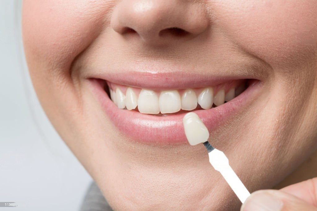 Zahnärztin bei der Planung von Veneers