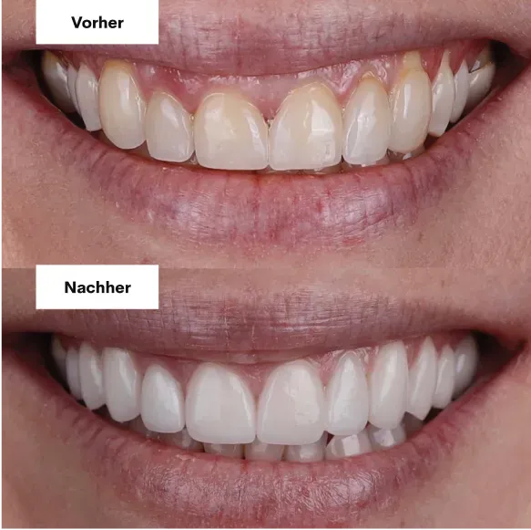 Zähne vorher und nachher mit Veneers, Beispiel 1