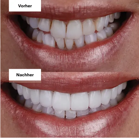 Zähne vorher und nachher mit Veneers, Beispiel 5