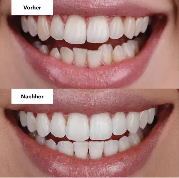 Zähne vorher und nachher mit Veneers, Beispiel 2