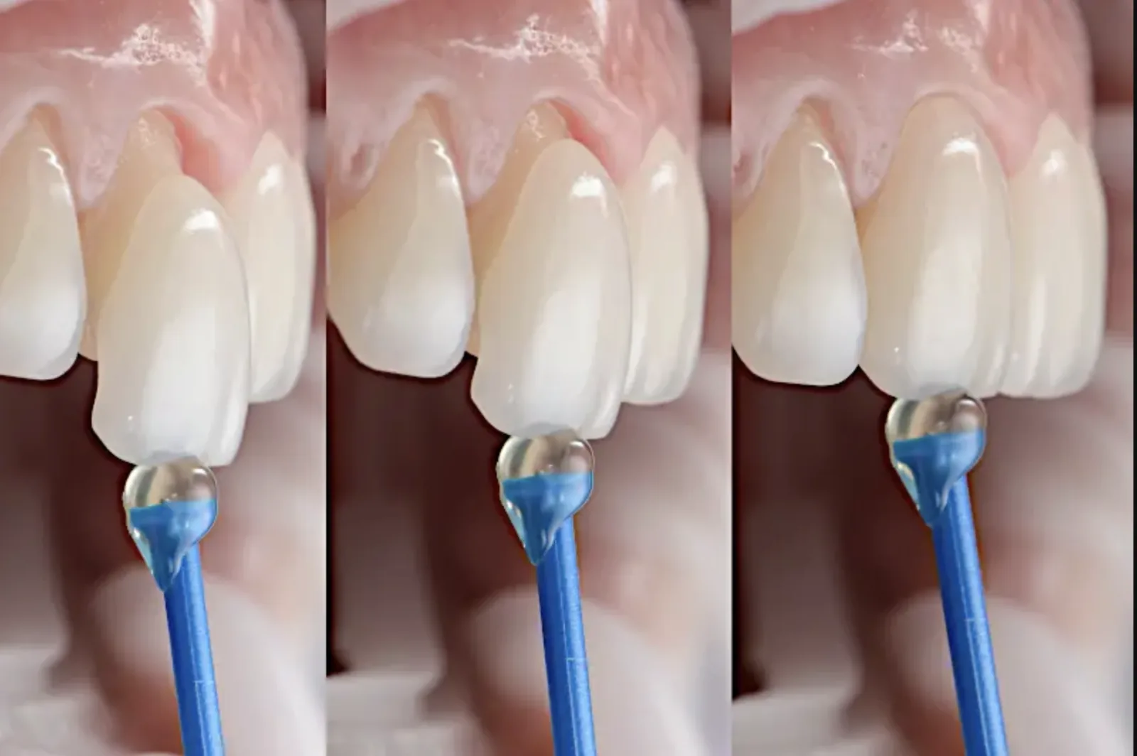 Patientin bei einer Veneers-Beratung