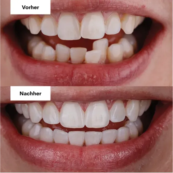 Vorher und nachher mit Alignern, Patient 3