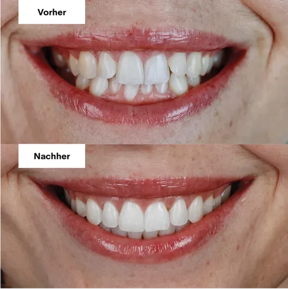 Vorher und nachher mit Alignern, Patient 4