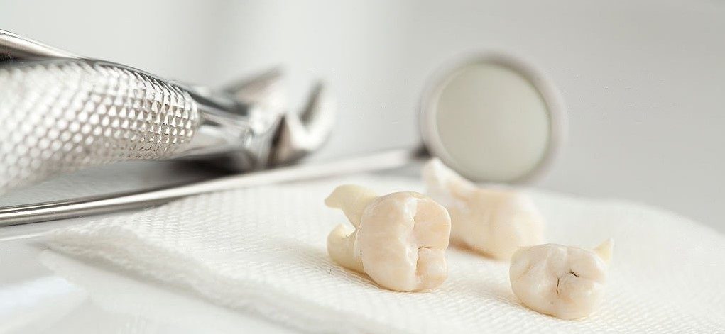 Gezogene Weisheitszähne neben zahnärztlichen Instrumenten